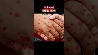 🦠 HPylori Infection Explained 😷 stomach infection shorts [upl. by Thorn]