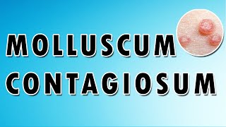 Molluscum Contagiosum Symptoms and Treatment [upl. by Steffen]