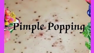 Pimple amp Blackheads Popping  52 [upl. by Tteirrah276]