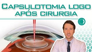 Capsulotomia para limpar a lente logo após cirurgia [upl. by Thorfinn]