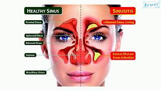 catarrh English  Medical terminology for medical students [upl. by Bessy896]