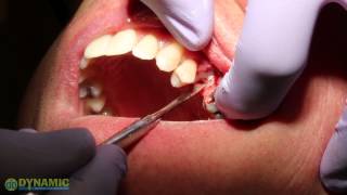 Bone Grafting for Socket Preservation [upl. by Bailey]