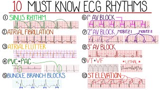 Most Common ECG Patterns You Should Know [upl. by Davine]