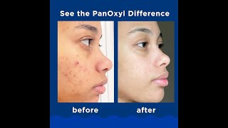 Panicky Acne Foaming Wash Benzoyl Peroxide 10 Maximum Strength Antimicrobial 55 Oz [upl. by Akeenahs]