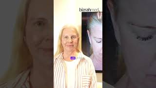 Deep Plane Face amp Neck lift Surgery  Face amp Neck Lift Surgery Before amp After [upl. by Annayat449]