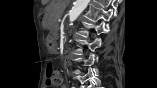 Diffuse  massive arterial thrombosis involving multiple organs CT findings [upl. by Htiekram531]