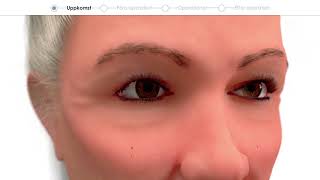 Patientfilm om ögonlocksplastik  förhandsvisning Eyelid surgery  preview [upl. by Dian]