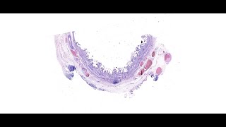 Parasitic Infection  CLONORCHIASIS GALL BLADDER  QUIZ CASE 3  DIGIPATH TUTORIALS [upl. by Amelina]