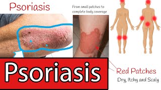 Psoriasis Symptoms and Treatment Everything you need to know about Psoriasis [upl. by Fadil91]