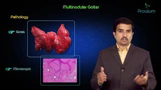 Multinodular goitre  Usmle step 1 pathology lecture and case presentation [upl. by Ferrigno]