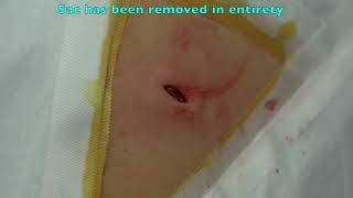 Interesting Epidermoid Cyst Removal [upl. by Arbuckle89]