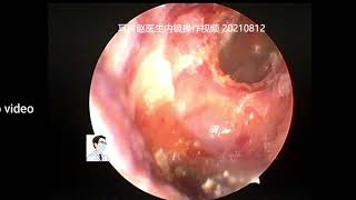 Ear wax removalManagement of a severe external auditory canal cholesteatoma 11 min [upl. by Norina]