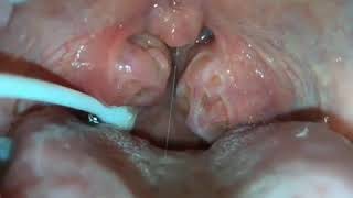 How to remove caseum from your tonsils [upl. by Gaspard]