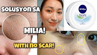 PAANO MAGTANGGAL NG MILIABUTLIG AT HOME Safe Easy amp Scar Free  FEAT Nivea Cream  ayaesguerra [upl. by Low172]