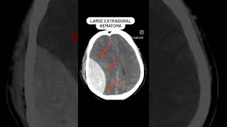 Extradural hematoma CT brain shorts viral shortsvideo [upl. by Yelsew]