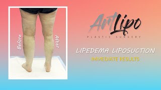 Lipedema Liposuction Surgery  Legs  Immediate Results  Cankles amp Knees  Expert Dr Thomas Su [upl. by Franciscka51]