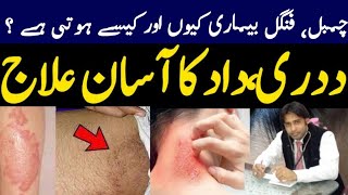 Fungal Infection treatment in urdu  Dad or Dadri k Ilaaj ka Tarika by Dr Raheel Shehzad Rathore [upl. by Jeannie258]