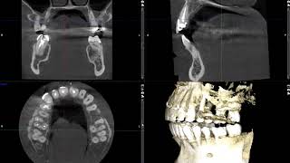 Buccal Exostosis [upl. by Aihsirt]