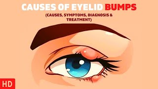 The Surprising Causes of Eyelid Bumps You Never Knew About [upl. by Najar]