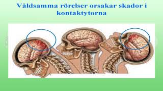 Föreläsning Kan whiplashvåld ge hjärnskador med dr Olle Bunketorp [upl. by Cherilynn]