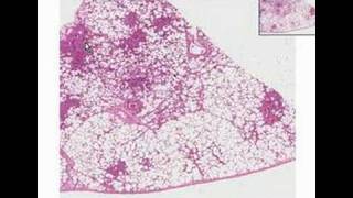 Histopathology LungBronchopneumonia [upl. by Yntrok]