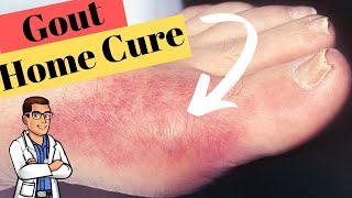 Gout Big Toe Joint Treatment BEST Home Remedies [upl. by Ume374]