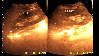 Fatty infiltration of the liver  Kidney Stone [upl. by Eilrak]