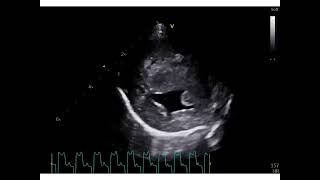 Neonatal hypertension Eisenmenger syndrome following a perimembranous ventricular septal defect [upl. by Adyol]