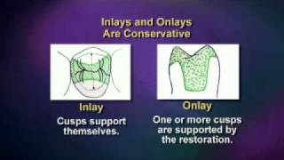 V1529  Esthetic Alternatives for Crowns  ToothColored Inlays and Onlays [upl. by Ardnusal756]