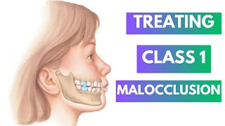 Management of Class 1 Malocclusion Orthodontics [upl. by Divod848]