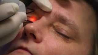 Xanthelasma laser treatment [upl. by Ahsirkal]