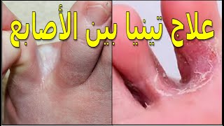 تينيا القدم  الاسباب وروشتة العلاج علاجتينياالقدم [upl. by Pattie]