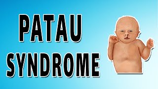 Patau Syndrome [upl. by Irahcaz]