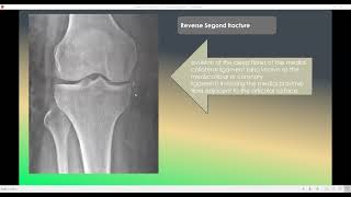 Reverse Segond Fracture [upl. by Ariane535]