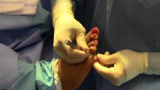 Hammer Toe 5th Digit Surgery  Dr Nagler [upl. by Haissem]