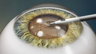 Dr Jon Weyer explains Refractive Lens Exchange [upl. by Lull]