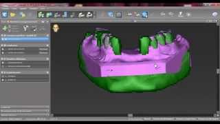 Tutorial n4 Importazione dellSTL in coDiagnostiX [upl. by Dyraj]