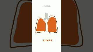 Emphysema vs Empyema medical cardiorespiratory physiotherapy [upl. by Anneyehc]