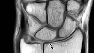 TFCC tear and ulnar collateral ligament complex tear [upl. by Jezrdna346]