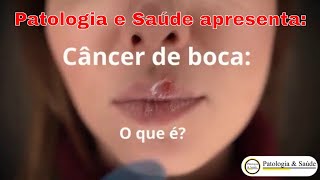 Câncer de boca o que é e como se prevenir [upl. by Anirdnajela]