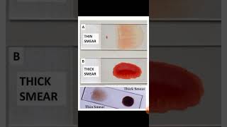 Thick or thin blood smear you should prepare [upl. by Verbenia]