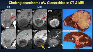 Varying appearances of cholangiocarcinomas according to predisposing conditions [upl. by Seraphina862]