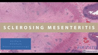 Sclerosing Mesenteritis [upl. by Idac]