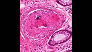 Pathology of Intestinal Schistosomiasis shorts infectiousdisease [upl. by Colier]