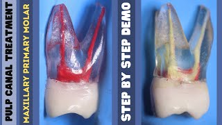 Pulp Canal Treatment 🟡 Maxillary Primary Molar 🔵 step by step demonstration [upl. by Rapp155]