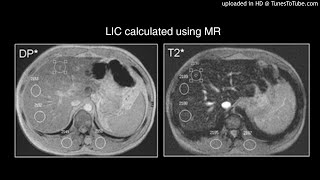 Cardiac and Hepatic Hemosiderosis as Measured by T2MRI [upl. by O'Brien137]