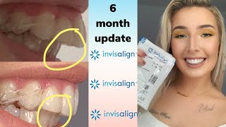 Invisalign Overbite Correction  6 Month UPDATE with before and after pics [upl. by Lleval]