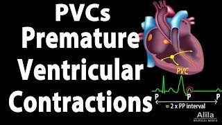 Premature Ventricular Contractions PVCs Animation [upl. by Hsara965]