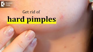 How to get rid of hard pimples  Dr Urmila Nischal [upl. by Carrew242]