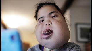 Teenager With Facial Tumour Proves Doctors Wrong  BORN DIFFERENT [upl. by Philipps789]